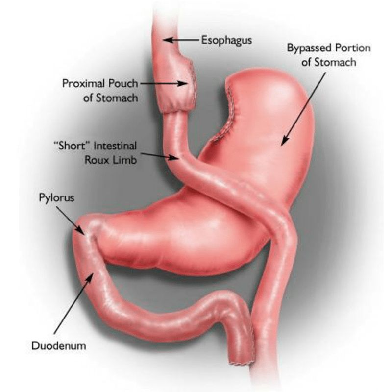 Bypass gástrico: cambio del tránsito digestivo